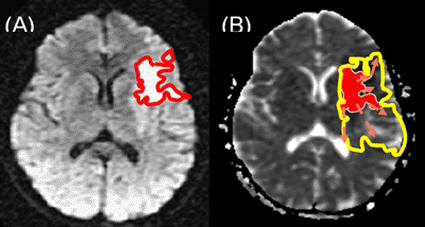 Image: On left (A) An infarct already formed is identified by a sequence of classic diffusion MRI. On right (B) Derived from the original diffusion MRI, the Infarct is plotted on the apparent diffusion chart. The NEURiNFARCT technique predicts the future of the infarct and its growth potential in the brain of the patient, allowing the neurologist to estimate the risk / benefit ratio of aggressive treatments (Photo courtesy of the Cognitive Neuroscience and Brain Imaging Laboratory of the French National Center for Scientific Research and the Acute Stroke Center of the Pitié-Salpêtrière General Hospital). Image: On left (A) An infarct already formed is identified by a sequence of classic diffusion MRI. On right (B) Derived from the original diffusion MRI, the Infarct is plotted on the apparent diffusion chart. The NEURiNFARCT technique predicts the future of the infarct and its growth potential in the brain of the patient, allowing the neurologist to estimate the risk / benefit ratio of aggressive treatments (Photo courtesy of the Cognitive Neuroscience and Brain Imaging Laboratory of the French National Center for Scientific Research and the Acute Stroke Center of the Pitié-Salpêtrière General Hospital).